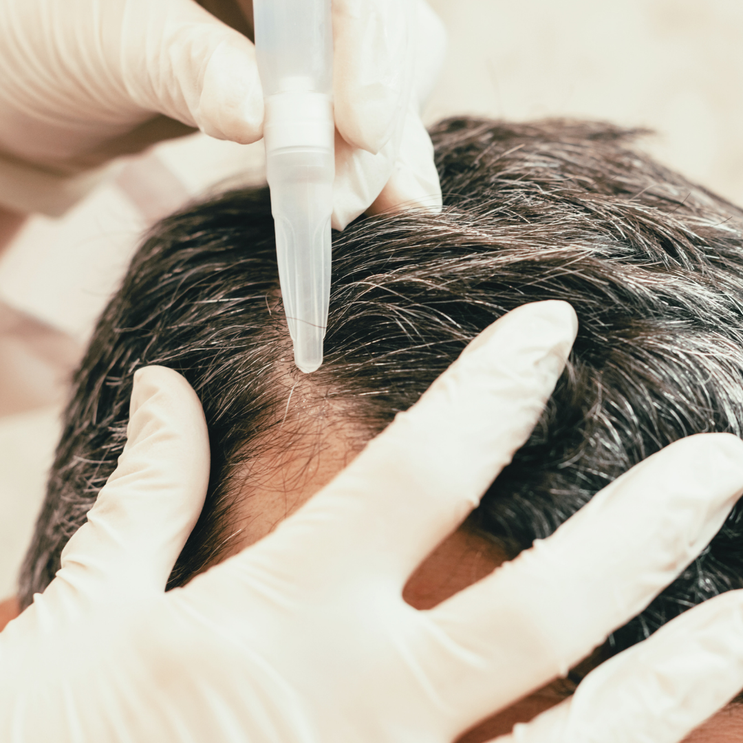 MINOXIDIL PARA LA CAÍDA DEL CABELLO: LO QUE NECESITAS SABER